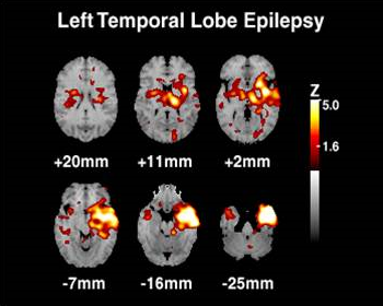 Image of left temporal lobe epilepsy